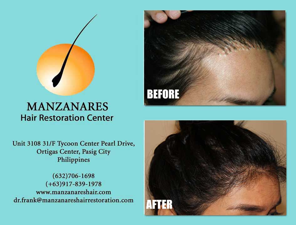 Corrective Procedures from Previous Restoration - Hair Transplant Manila Philippines by Manzanares Hair Restoration Center