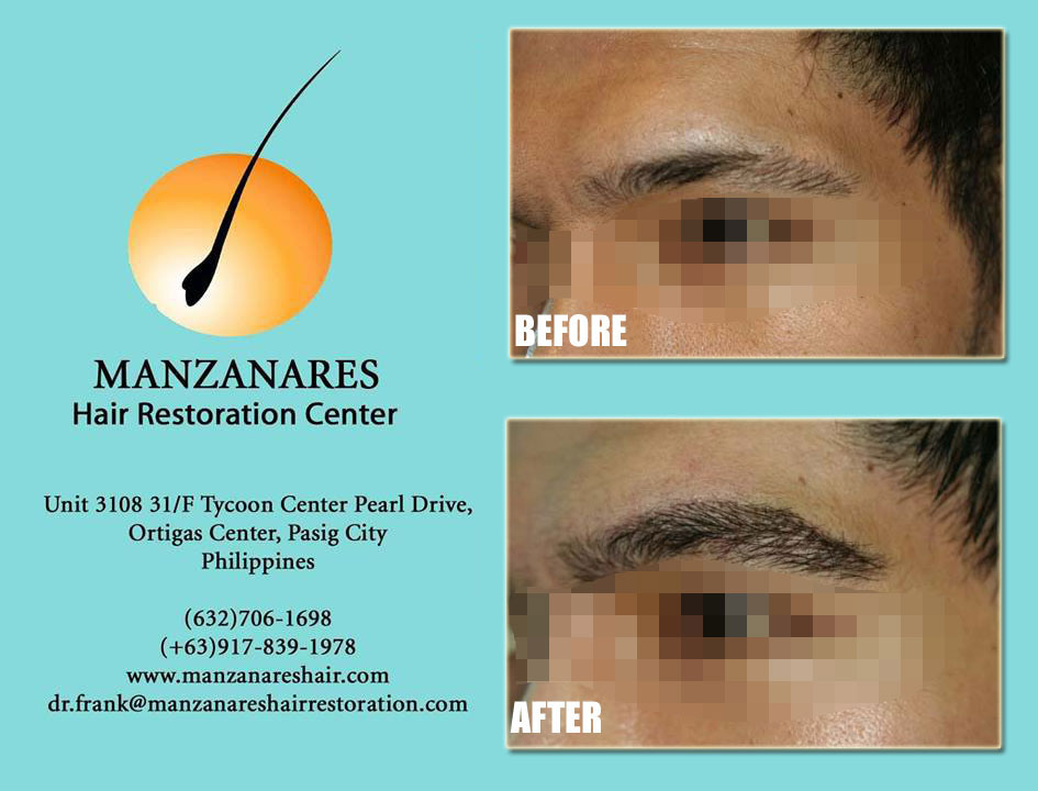 Eyebrow Hair Transplant for Men Manila Philippines by Manzanares Hair Restoration Center
