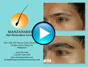 Eyebrow Hair Transplant Manila Philippines by Manzanares Hair Restoration Center