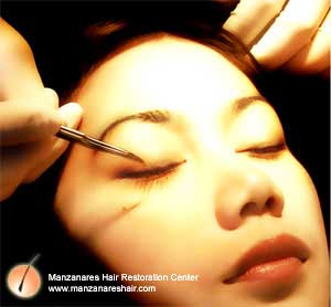 Eyelash Hair Transplant Manila Philippines by Manzanares Hair Restoration Center