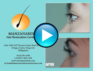 Eyelash Hair Transplant Procedure by Manzanares Hair Restoration Center