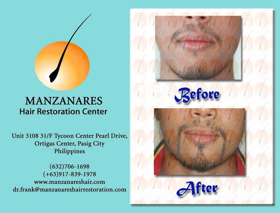 Facial Hair Transplant (Mustache and Goatee) by Manzanares Hair Restoration Center