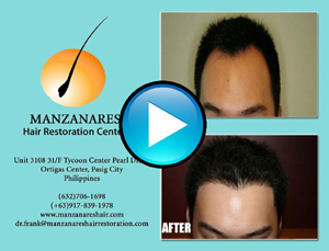 Hair Transplant Manila Philippines by Manzanares Hair Restoration Center