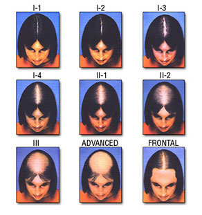 Ludwig Scale for Women's Hair Loss Hair Transplant Manila Philippines Manzanares Hair Restoration Center