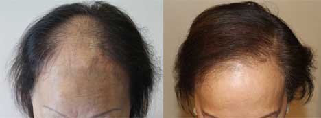 Women's Hair Loss Hair Transplant Manila Philippines Manzanares Hair Restoration Center
